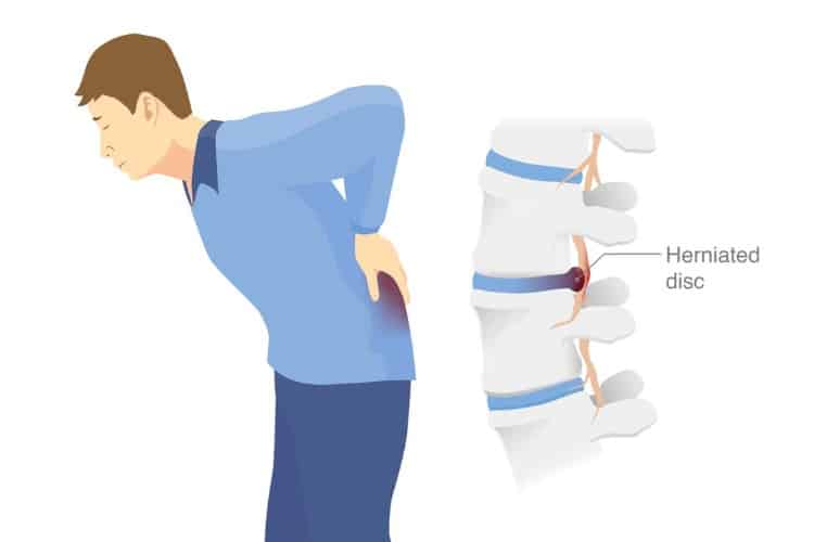 Understanding trapped nerves with herniated disc back pain