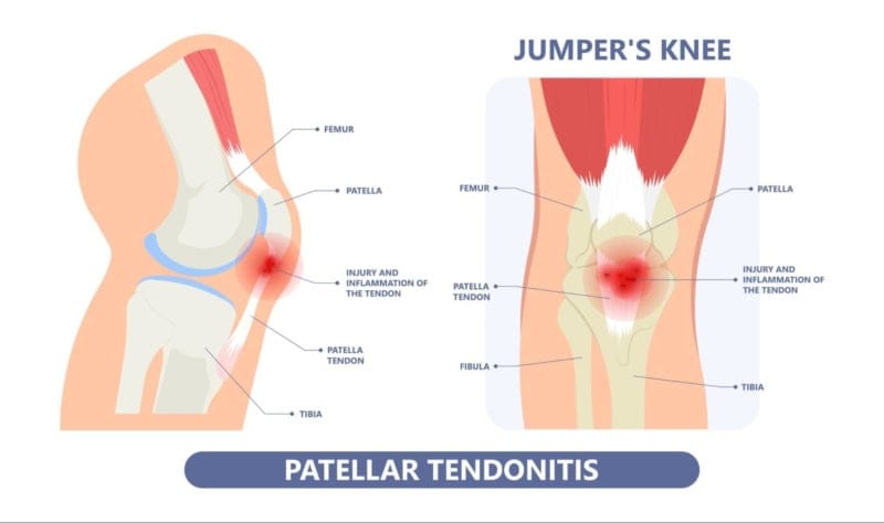 What jumper’s knee looks like and why it causes pain