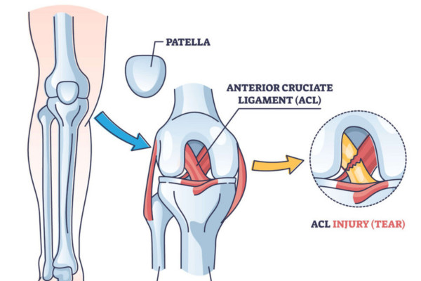 What Is ACL Injury​?