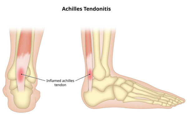 What Is Achilles Tendinitis​?