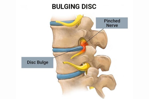 What Is Bulging Disc​?