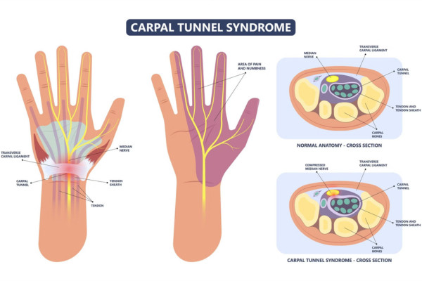 What Is Carpal Tunnel Syndrome​