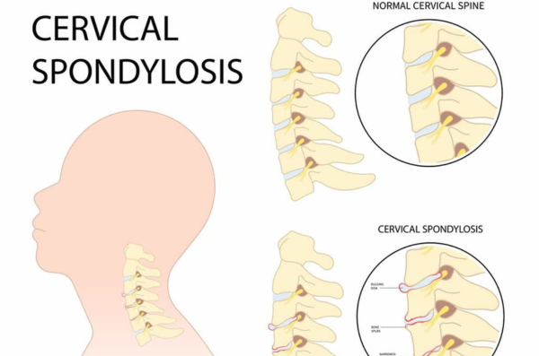 What Is Cervical Spondylosis​?