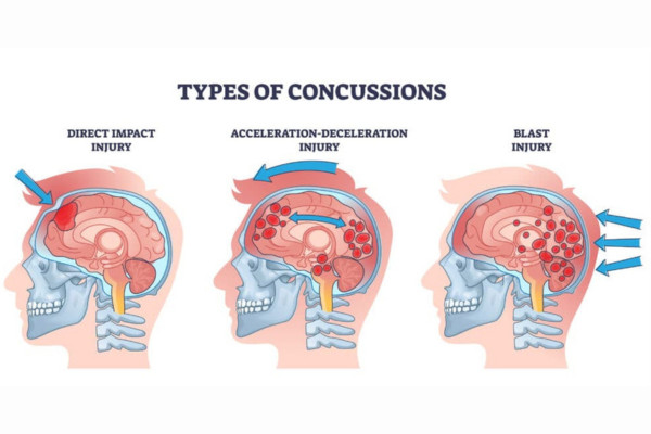 What Is Concussion​?