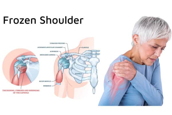 What Is Frozen Shoulder