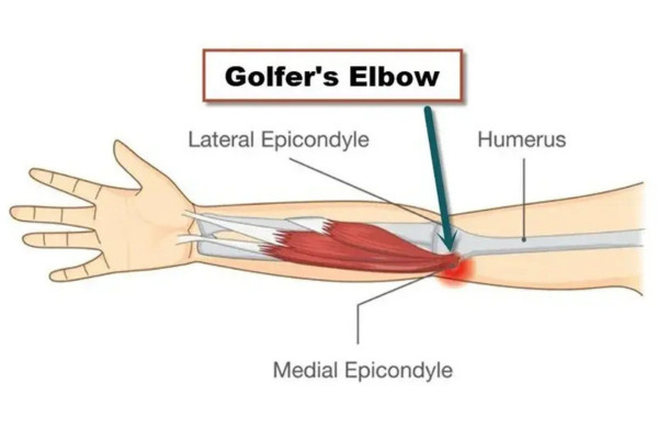 What Is Golfers Elbow​