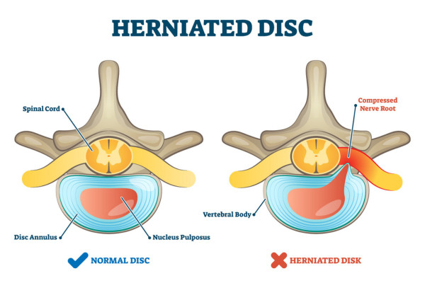 What Is Herniated Disc​?