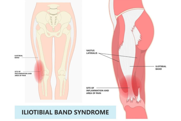 What Is Iliotibial Band Syndrome​?
