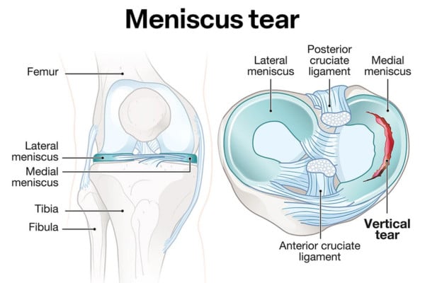 What Is Meniscus Tear​?