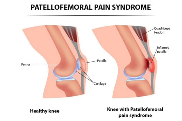 What Is Patellofemoral Pain Syndrome​?
