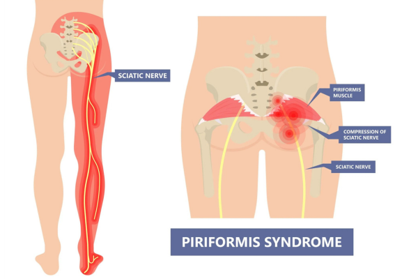 Piriformis Muscle Ways To Sit With Sciatica Piriformis Syndrome
