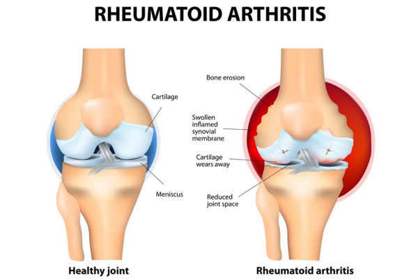 What Is Rheumatoid Arthritis​?