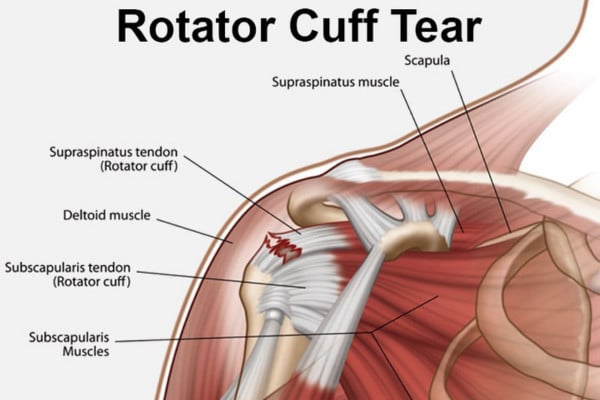 What Is Rotator Cuff Tear​