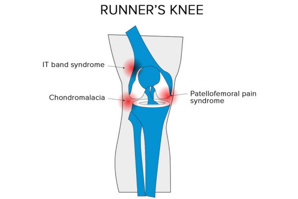 What Is Runners Knee​?