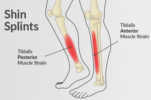 What Is Shin Splints​?