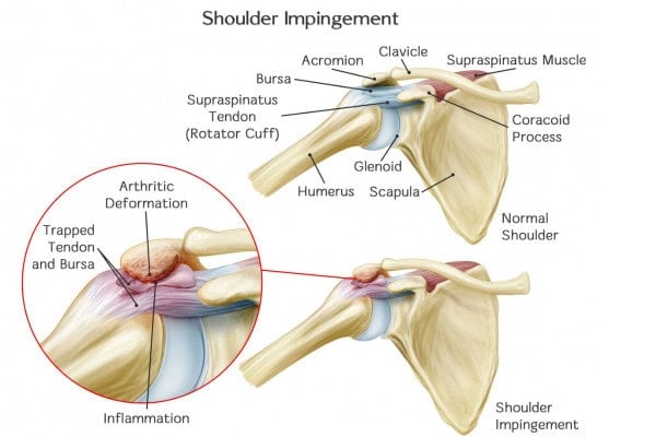 What Is Shoulder Impingement.