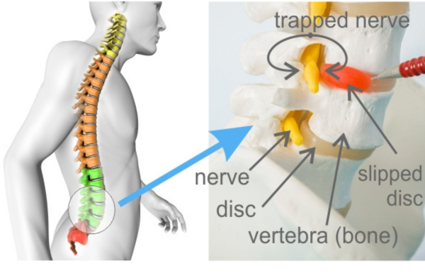Trapped Nerve Treatment London One Body LDN