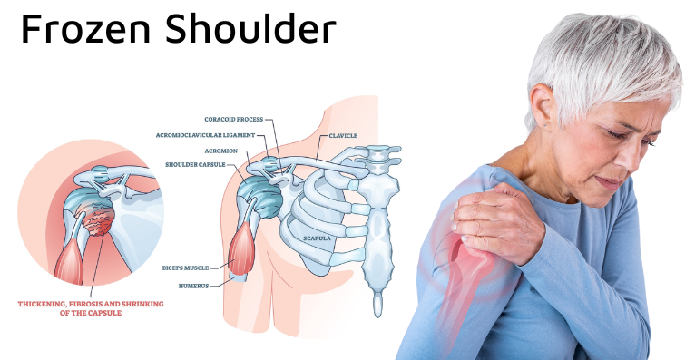 What Is Frozen Shoulder