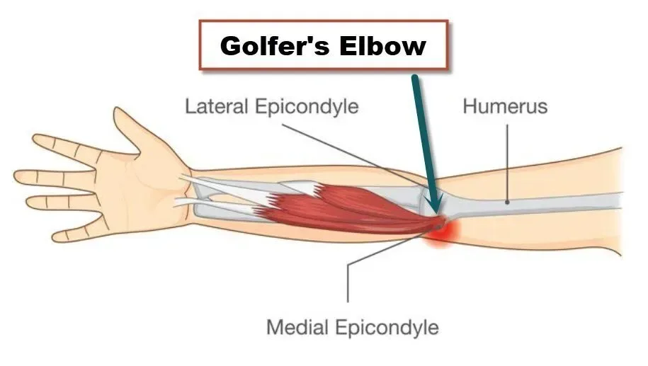 What Is Golfers Elbow​
