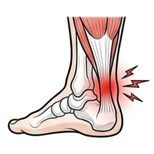 Achilles-Tendonitis with red spot indicate pain