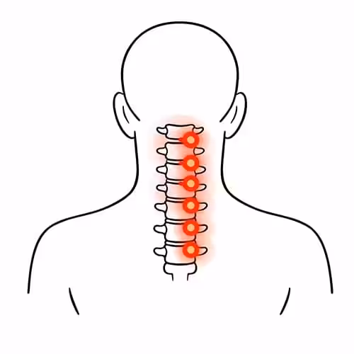 Pain in the cervical spine causing neck discomfort and stiffness.