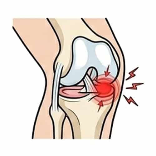 Meniscus Tear Symptoms