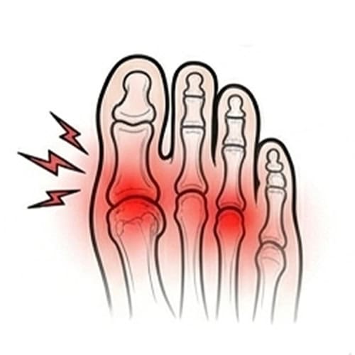 Metatarsalgia with red spot indicate pain