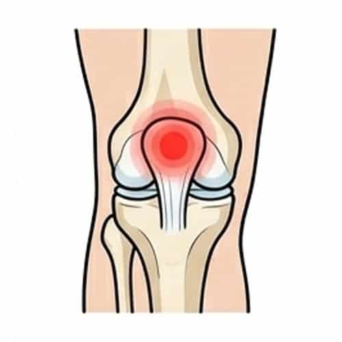 Patellofemoral-Pain with red spot indicate pain
