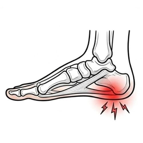 Plantar-Fasciitis with red spot indicate pain