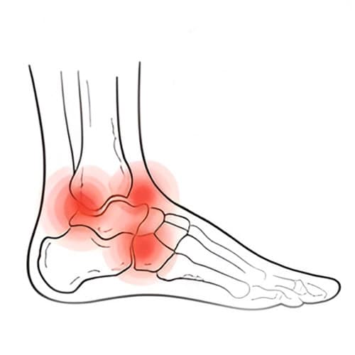 Posterior-Tibial-Tendon with red spot indicate pain