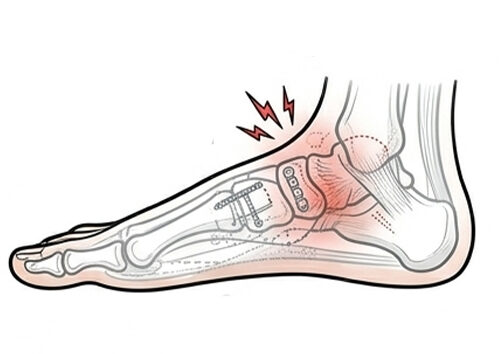 Post‑Injury with red spot indicate pain