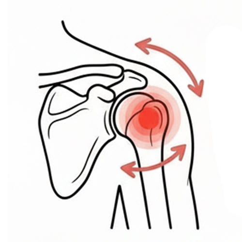Do Rotator Cuff Tears Need Surgery?