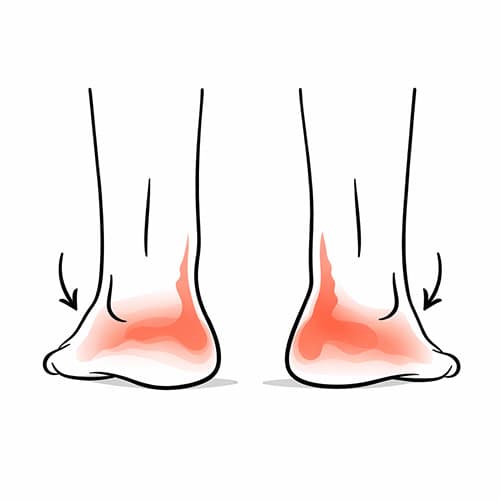 flat-feet with red spot indicate pain
