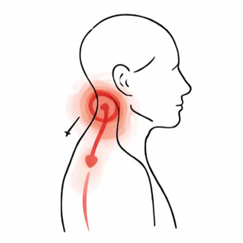 Illustration of neck pain with red area and nerve pain pathway.